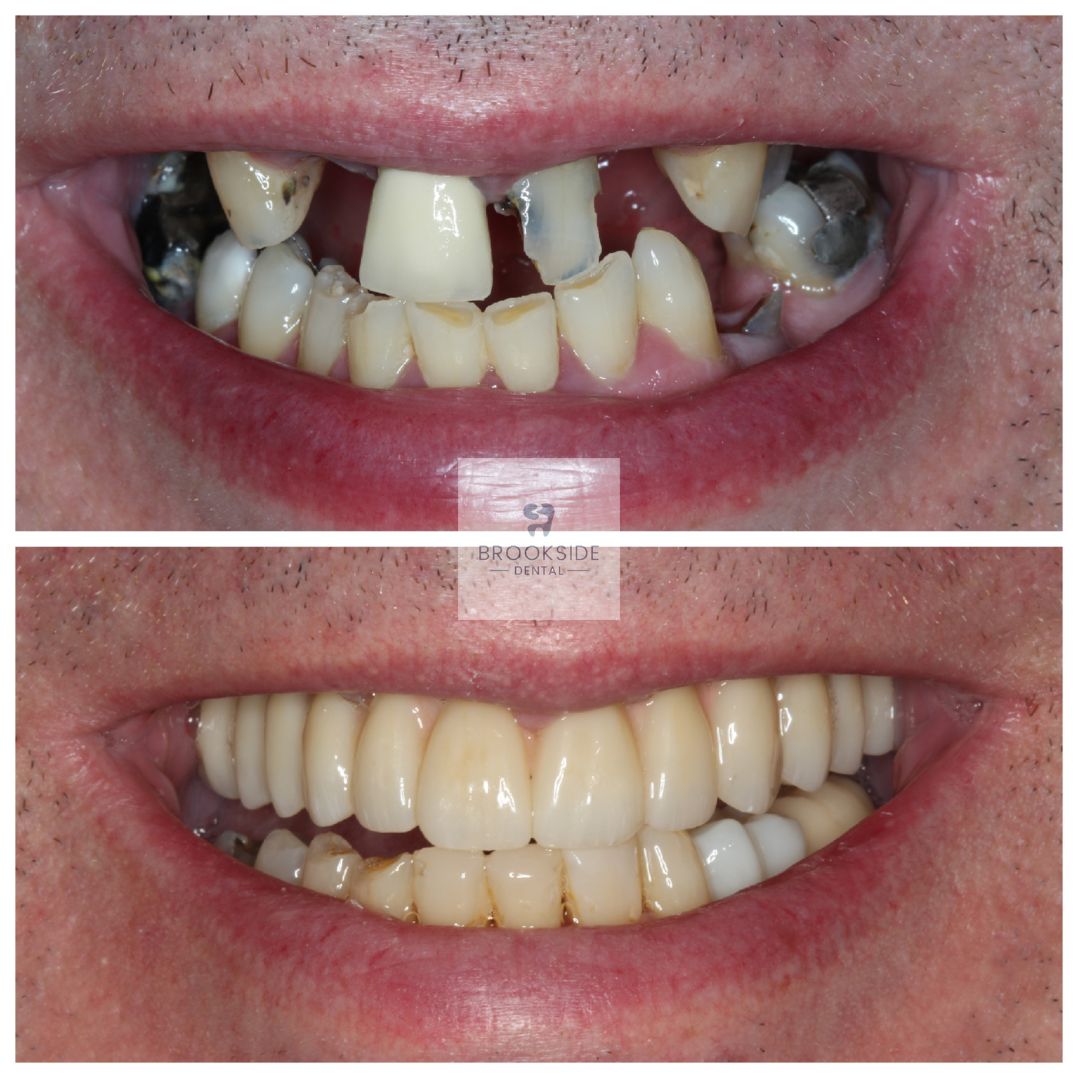 The best dental implants in Market Harborough Replace missing teeth